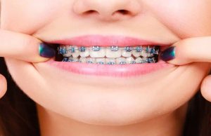 When is Two-Phase Orthodontics Recommended?