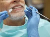 Do lifestyle habits affect the lifespan of dental veneers?