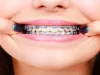 Are KLOwen Custom Braces More Comfortable than Traditional Braces?