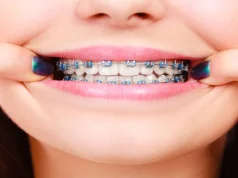 Are KLOwen Custom Braces More Comfortable than Traditional Braces?