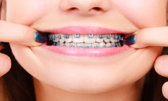are_klowen_custom_braces_more_comfortable_than_tra_32585168_featured.webp